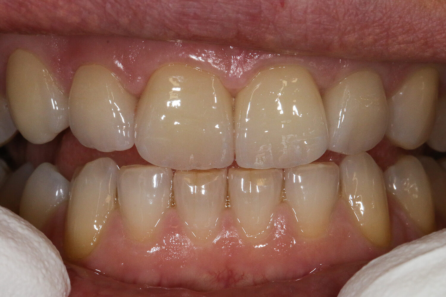 Nachher: Bild zeigt nun grö´ßere Zähne, die harmonisch aneinander abschließen. 