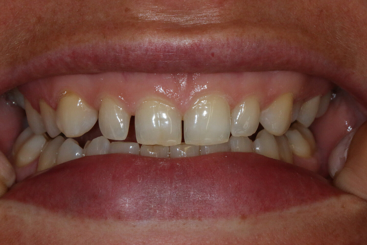 Vorher: Bild zeigt Zähne, die klein sind und deutliche Lücken aufweisen.